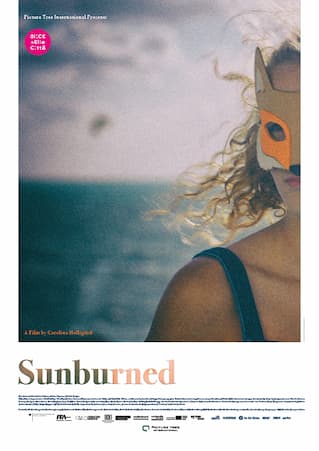 Sunburned